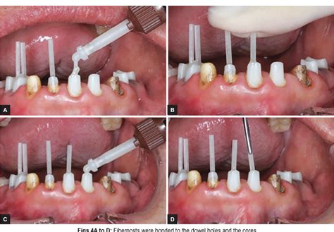 Dental post - Feb 2, 2021 · A post and core helps anchor a dental crown on top of a tooth to shield it from infection and further damage. Last medically reviewed on February 2, 2021 How we reviewed this article: